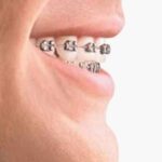 Dental Braces